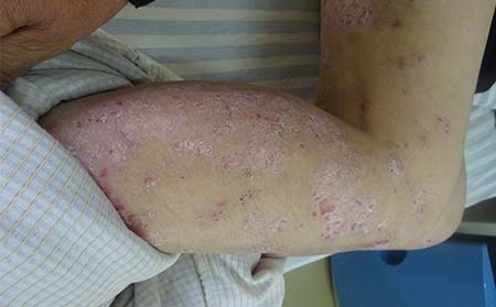 牛皮癣要怎么用药治疗