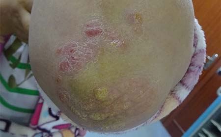 怎样才能更好的治疗好牛皮癣