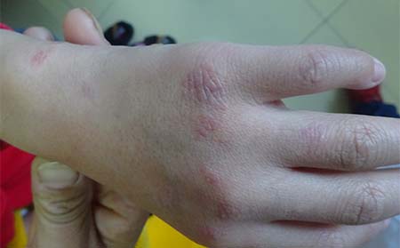 早期牛皮癣疾病可以怎么治疗呢
