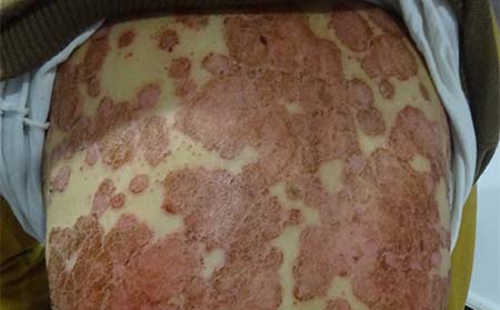 患上了牛皮癣有希望治好吗