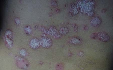 哪些因素会诱发牛皮癣的出现