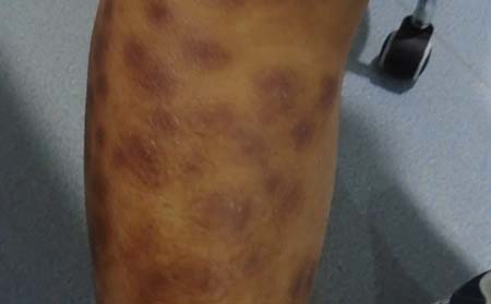 牛皮癣会遗传给孩子