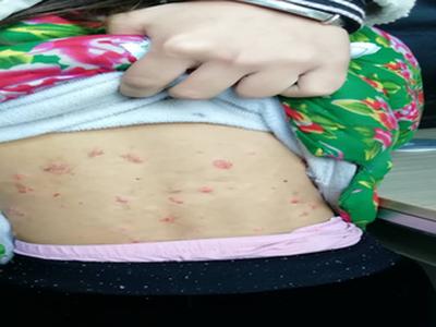 牛皮癣该怎么正确治疗